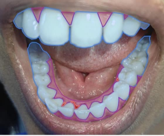 P2356 · lower_center — gingivite, en conditions cliniques