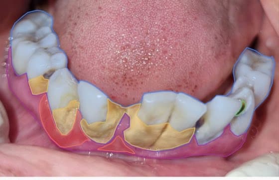 P2364 · lower_center — tartre et gingivite