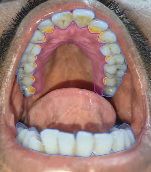 Photographie intra-orale annotée — arcade supérieure, tartre