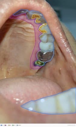 Vue upper_left du patient P2389, annotée
